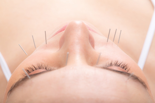 beneficios de la acupuntura